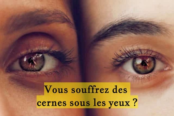 Vous souffrez des cernes sous les yeux ?