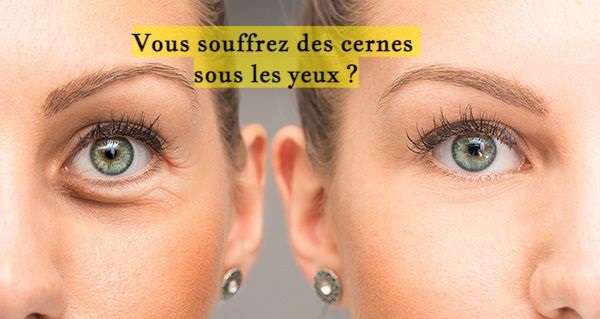 Vous souffrez des cernes sous les yeux ?