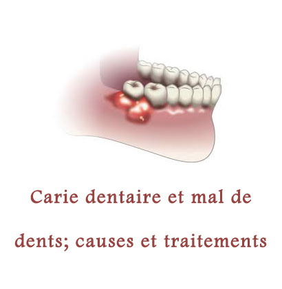 Carie dentaire et mal de dents; causes et traitements 