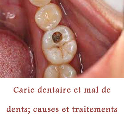 Carie dentaire et mal de dents; causes et traitements 