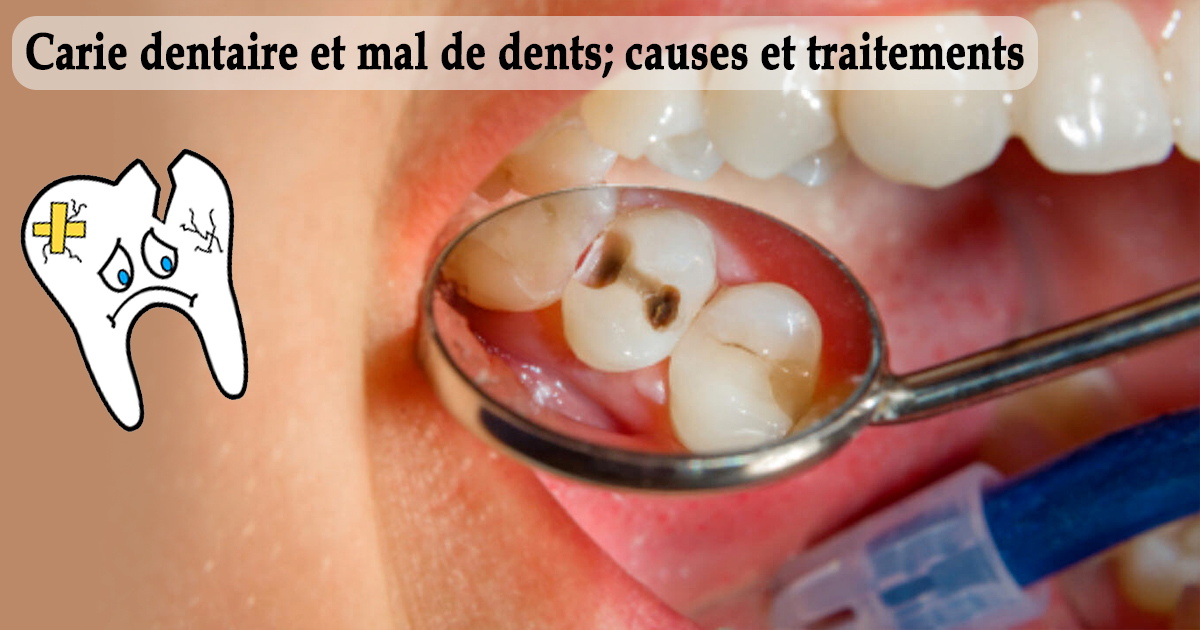 Carie Dentaire Et Mal De Dents Causes Et Traitements 