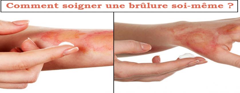 Comment soigner une brûlure soi-même ?