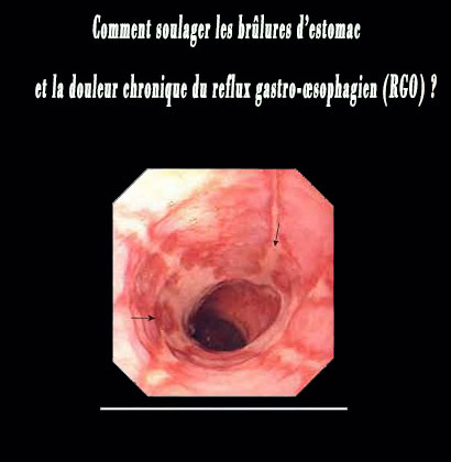 Comment soulager les brûlures d’estomac et la douleur chronique du reflux gastro-œsophagien (RGO) ?