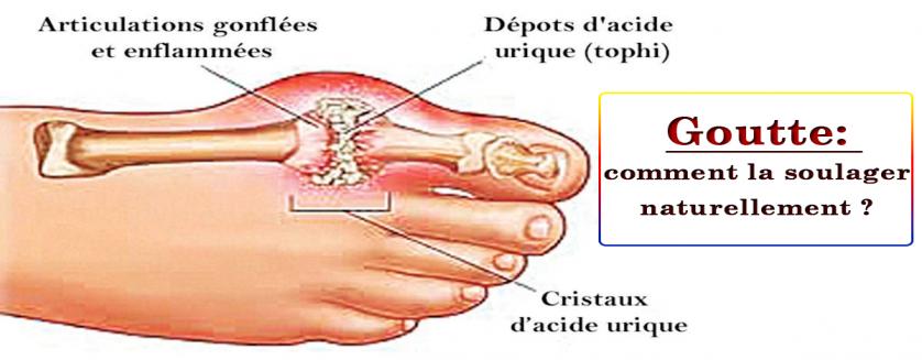 Goutte: comment la soulager naturellement ?