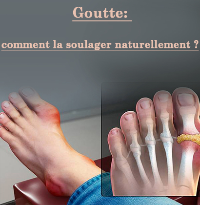 Goutte: comment la soulager naturellement ?