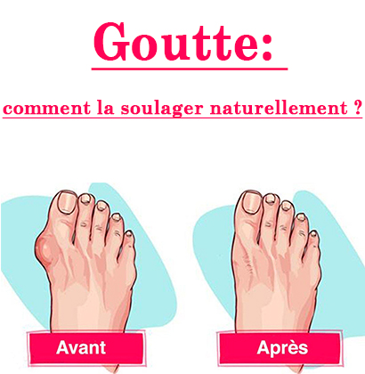 Goutte: comment la soulager naturellement ?