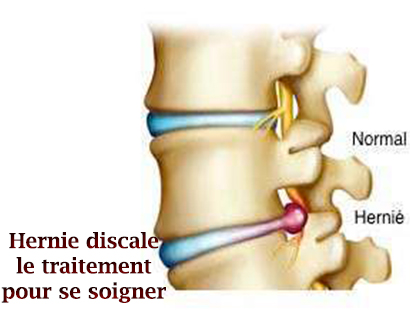 Hernie discale le traitement pour se soigner