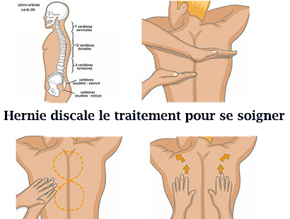 Hernie discale le traitement pour se soigner