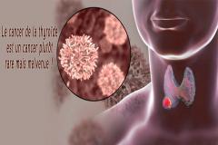 Les cancers de la thyroïde se manifestent principalement par un nodule, le plus souvent découvert à la palpation du cou ou lors d’examens d’imagerie.