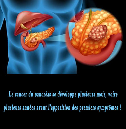 Le cancer du pancréas se développe plusieurs mois, voire plusieurs années avant l’apparition des premiers symptômes !