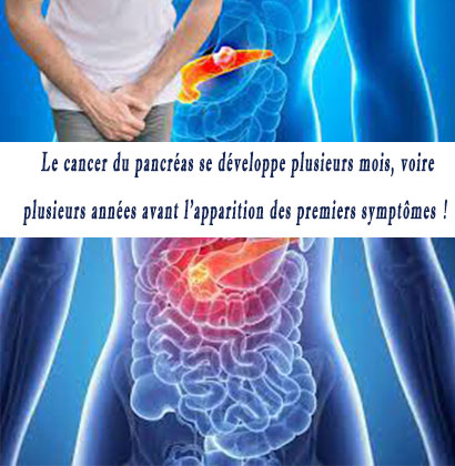 Le cancer du pancréas se développe plusieurs mois, voire plusieurs années avant l’apparition des premiers symptômes !