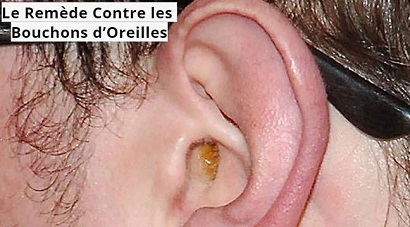 Le Remède Contre les Bouchons d’Oreilles