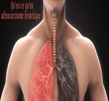 On distingue deux principaux groupes de cancer du poumon : « les cancers bronchiques à petites cellules » étroitement liés à la consommation tabagique et « les cancers bronchiques non à petites cellules », comprenant essentiellement les adénocarcinomes (dérivés des cellules glandulaires des bronches).