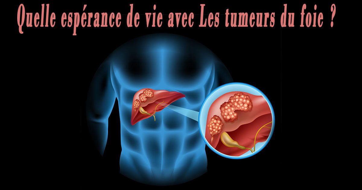Quelle espérance de vie avec Les tumeurs du foie