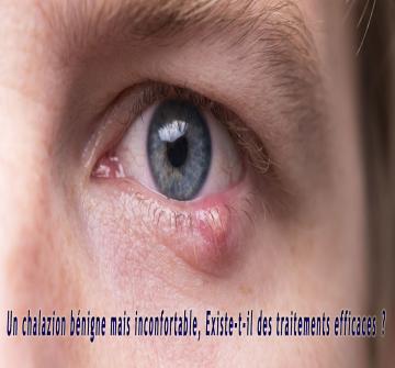 Un chalazion est une affection oculaire fréquente résultant de l’inflammation d’une glande au niveau de la paupière. Bien que sans gravité, il peut être douloureux et gênant.
