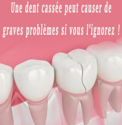 Une dent cassée peut causer de graves problèmes si vous l'ignorez !