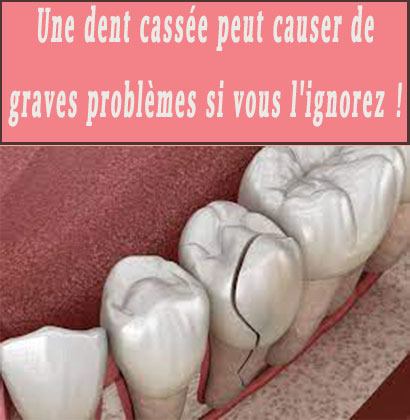 Une dent cassée peut causer de graves problèmes si vous l'ignorez !