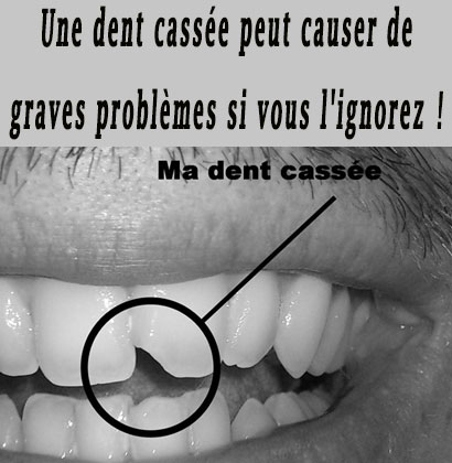 Une dent cassée peut causer de graves problèmes si vous l'ignorez !