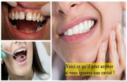 Ne repoussez jamais une visite chez le dentiste si vous suspectez avoir une cavité.Voici ce qu’il peut se passer si vous négligez une cavité sur l’une de vos dents