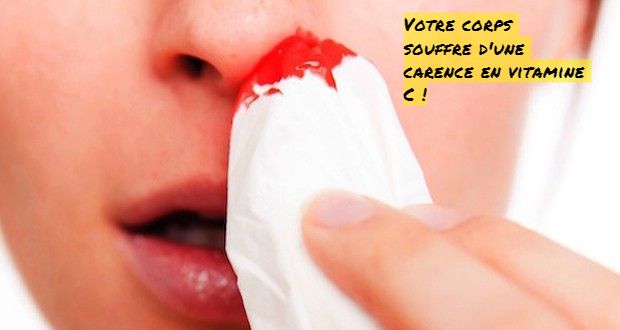 Votre corps souffre d'une carence en vitamine C