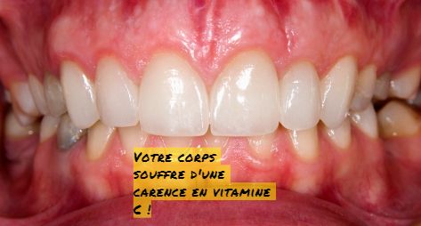 Votre corps souffre d'une carence en vitamine C