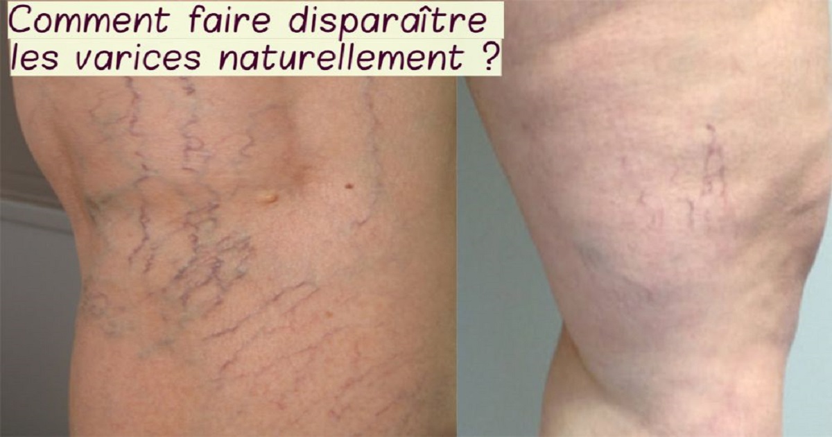 Comment faire disparaître les varices naturellement