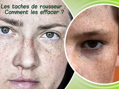 Les taches de rousseur : Comment les effacer ?