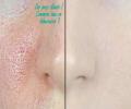 Surtout les femmes se donnent beaucoup de mal pour cacher les pores dilatés. Elles utilisent pour ce faire au moins trois produits.